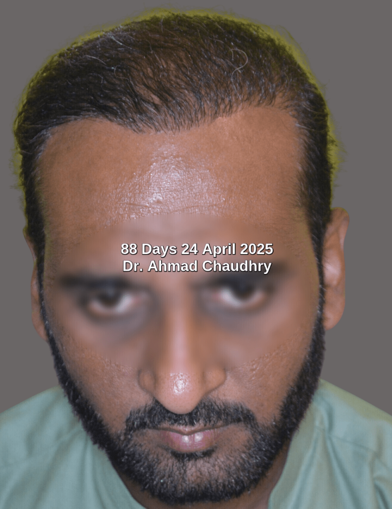 Bad hair transplant fixing 3 session results
