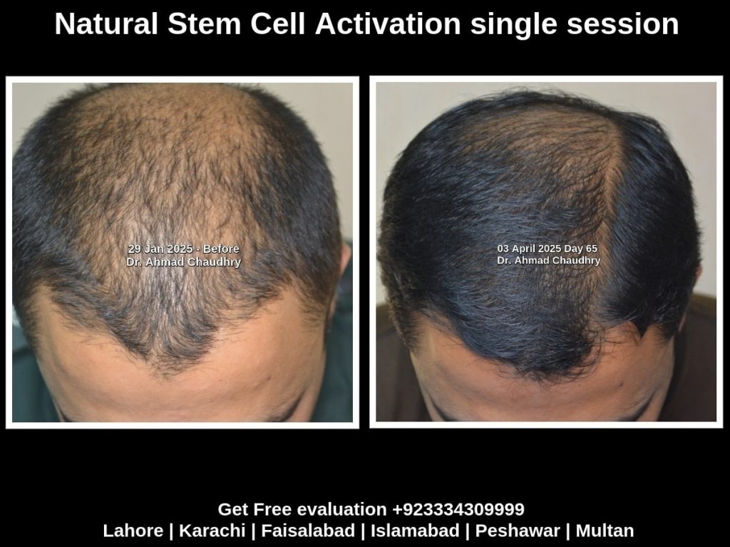 Best hair thinning treatment results