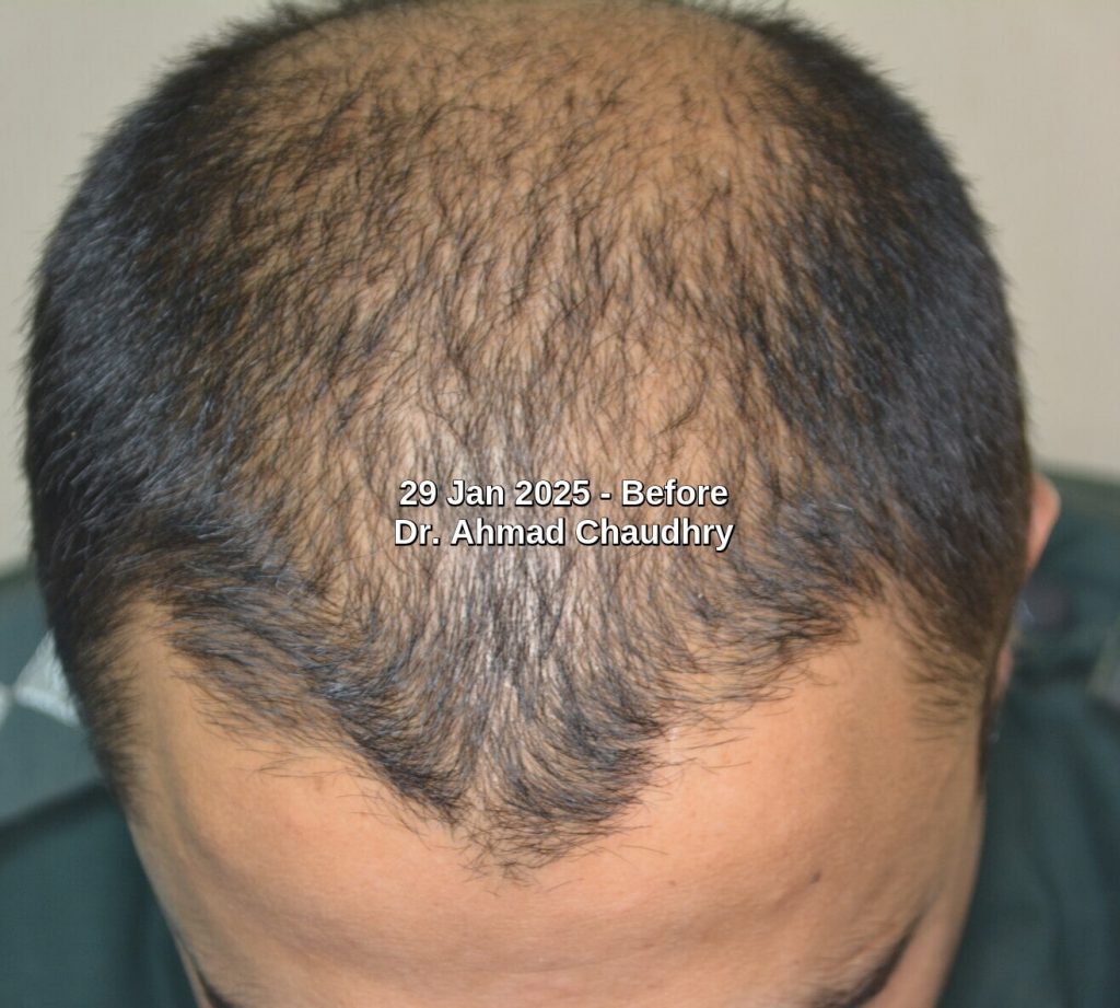 Hair thinning before treatment