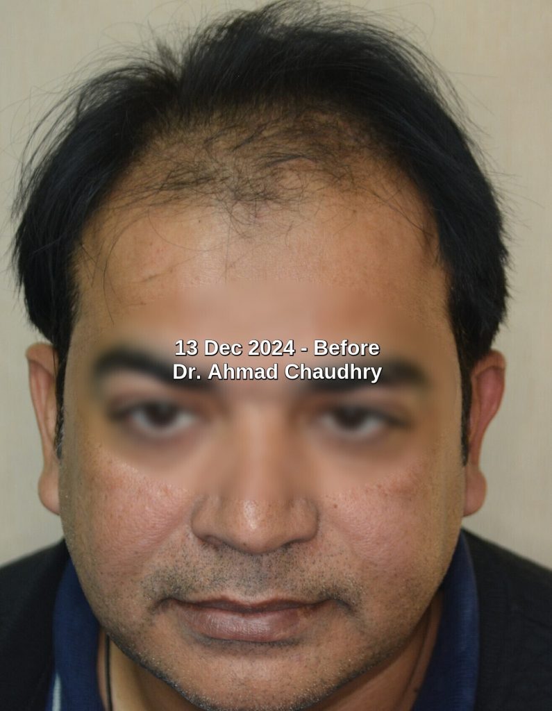 Thinning hair men