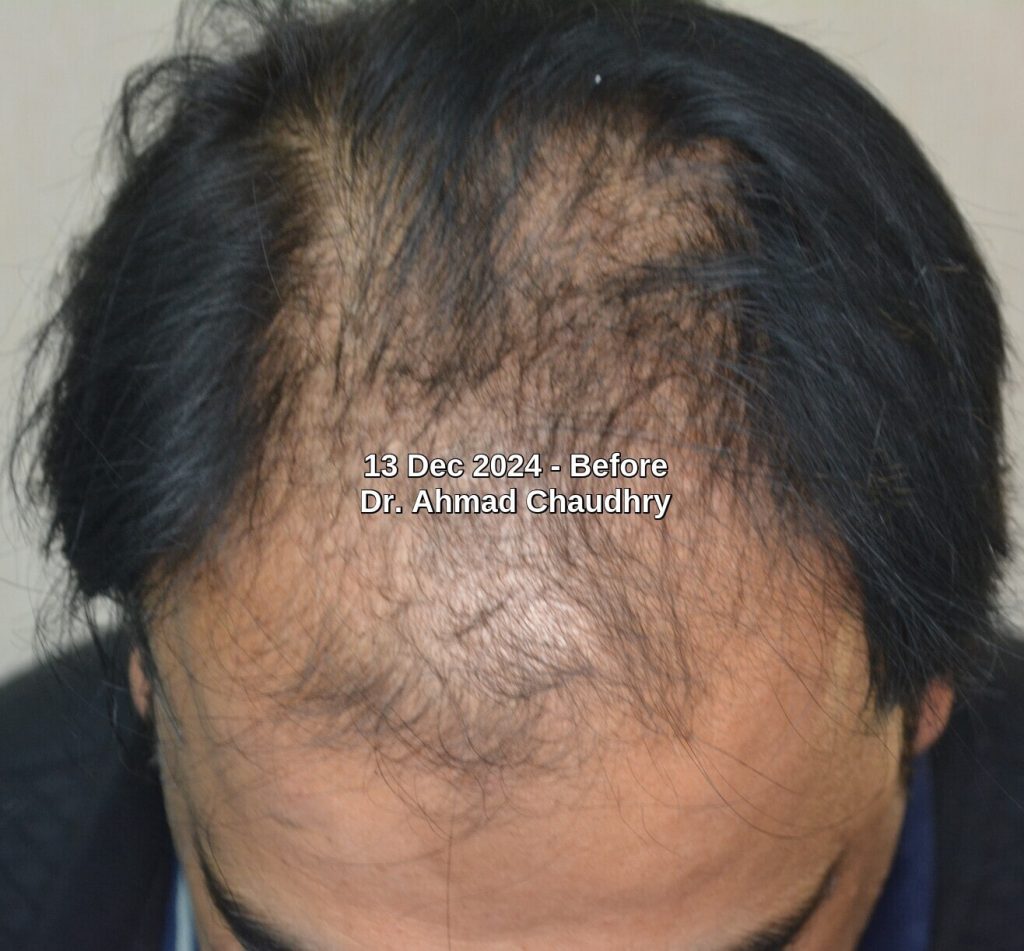 frontal partial baldness before