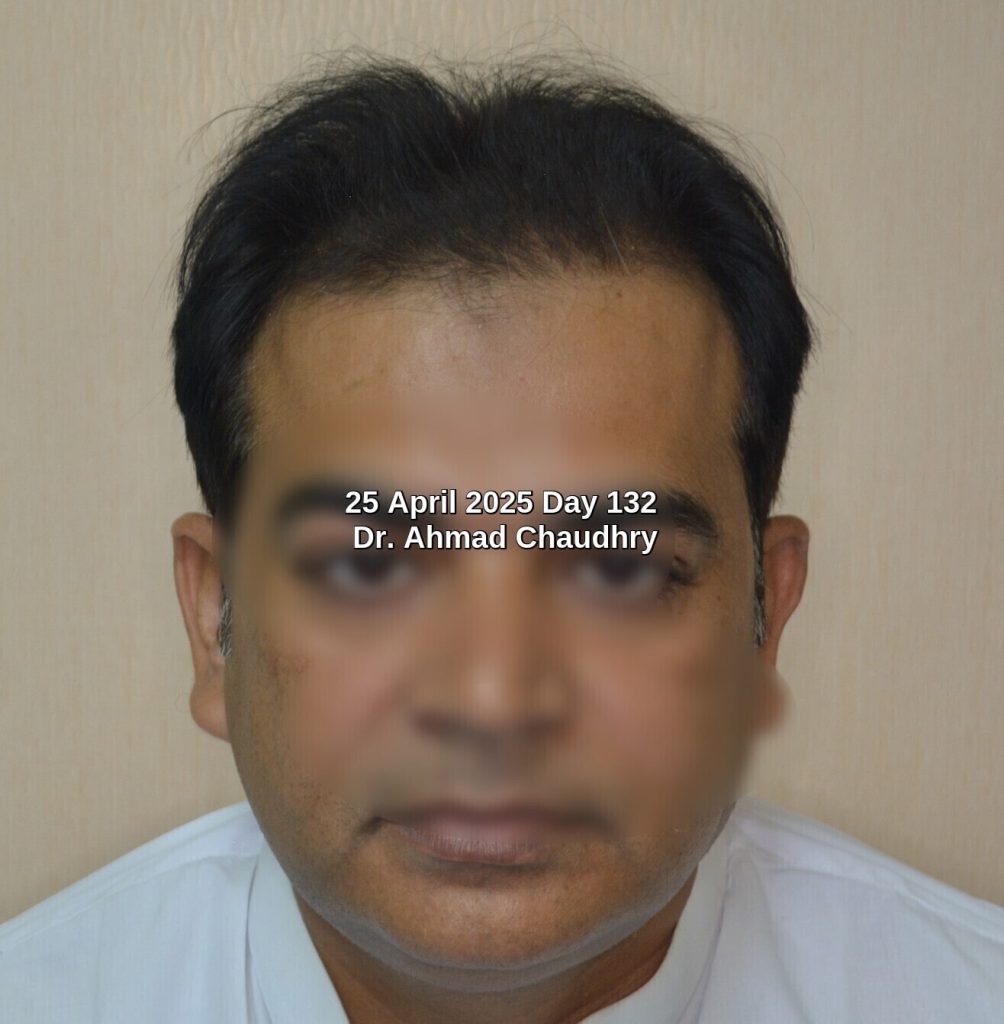 male thinning hair treatment results Pakistan