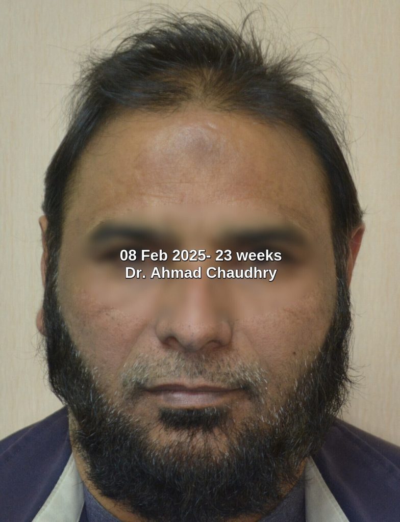 23 Weeks baldness regrowth results