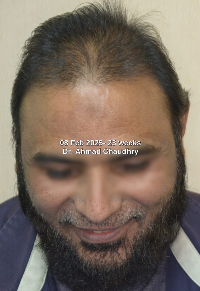 23rd week improvement baldness reversal naturally