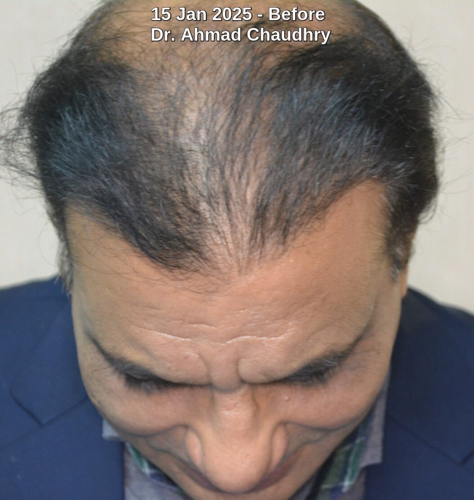 Central hair thinning after hair transplant