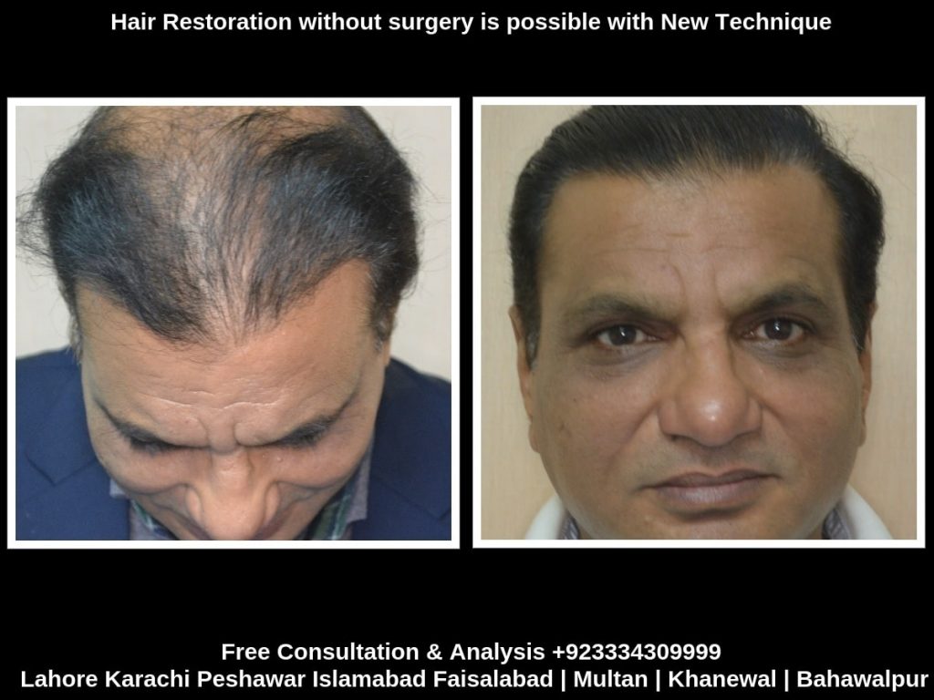 Hair restoration without surgery results
