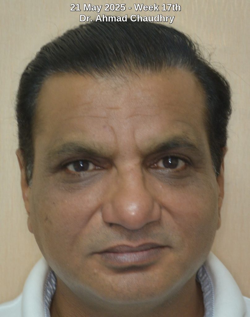 Natural hair restoration or growth results