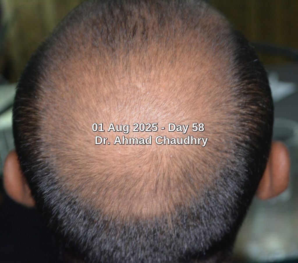 2 months hair growth results Dr Ahmad Chaudhry