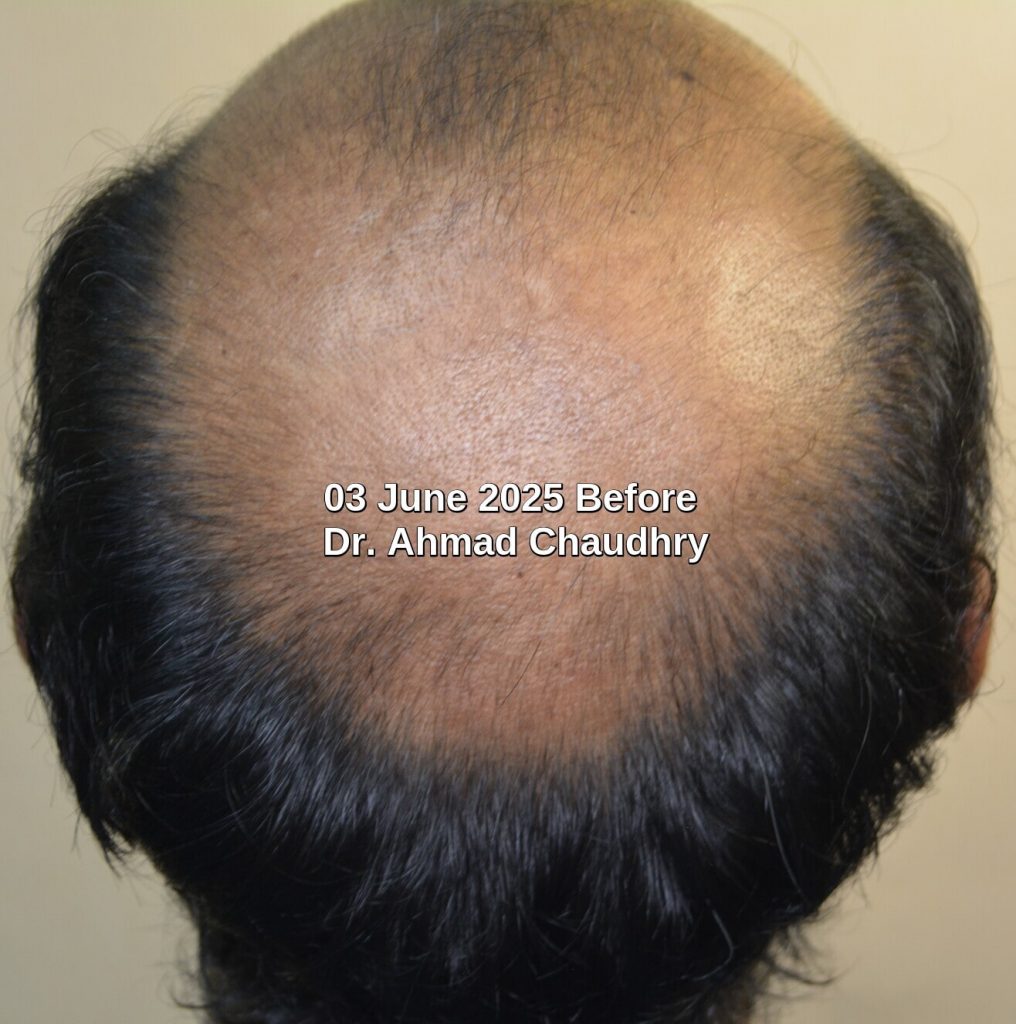 Crown area baldness treatment possible