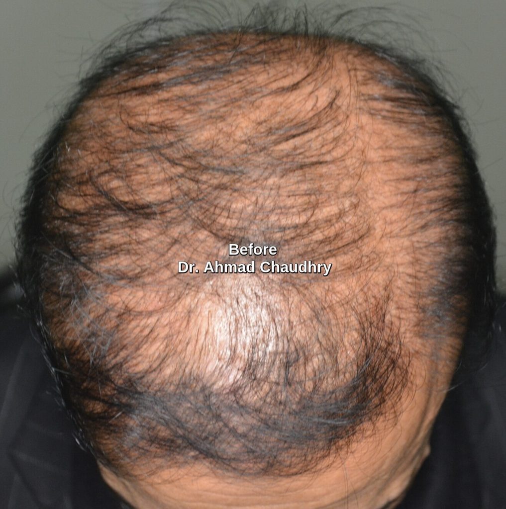 Hair thinning after hair transplant Hair thinning after hair transplant