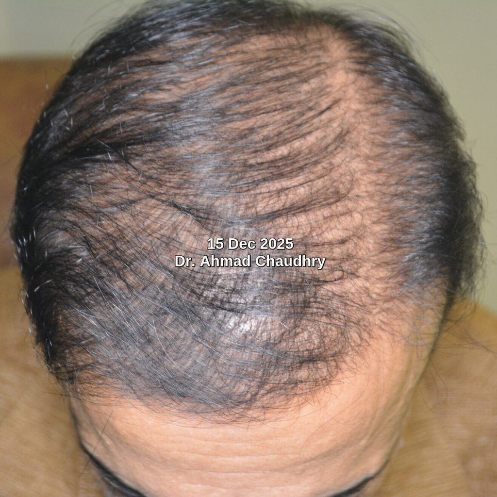 Hair thinning density improvement results Hair thinning density improvement results