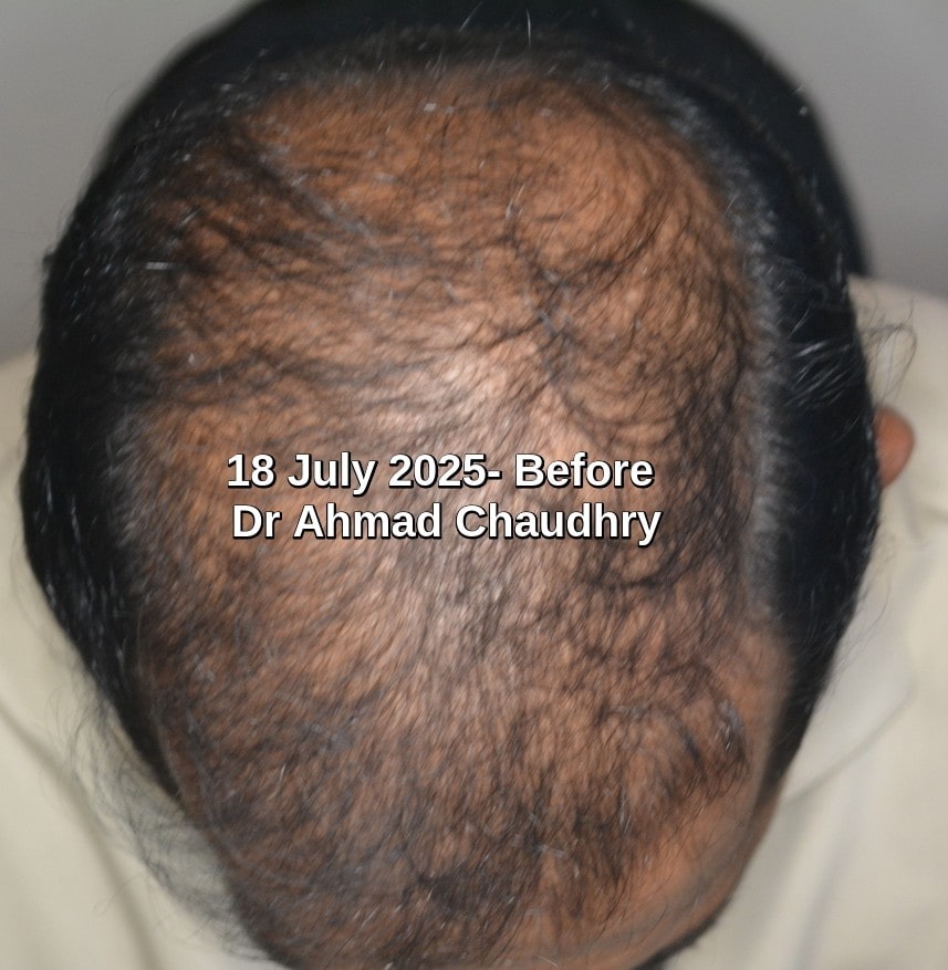Before hair treatment thinning Before hair treatment thinning