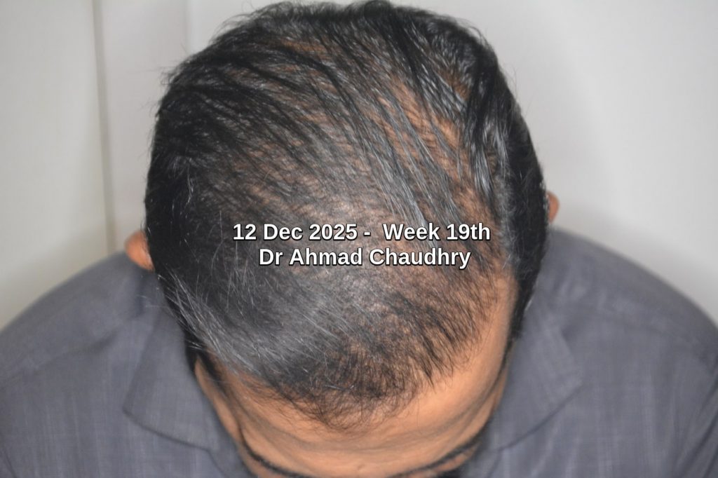 Best hair growth therapy before after Best hair growth therapy before after